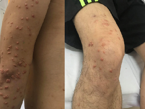 Nặn mụn ở miệng, người đàn ông không ăn được và biến dạng miệng nặng nề-3