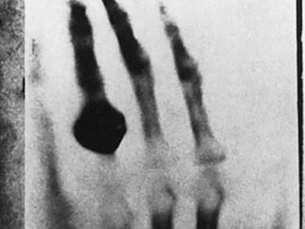 Sự thật cay đắng phía sau tấm ảnh chụp X-quang đầu tiên trên thế giới
