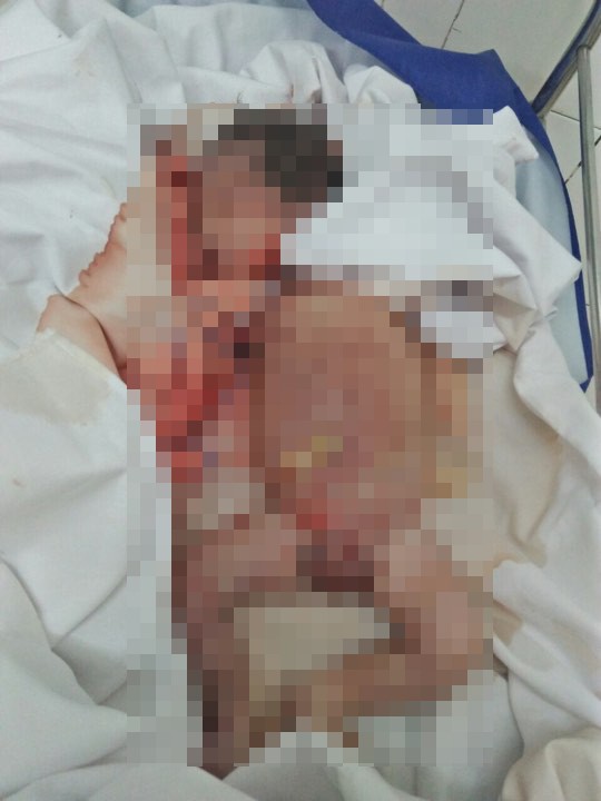 Thông tin chính thức vụ trẻ sơ sinh tử vong với vết đứt quanh cổ: Thai chết lưu 7 ngày trước khi vào bệnh viện-1