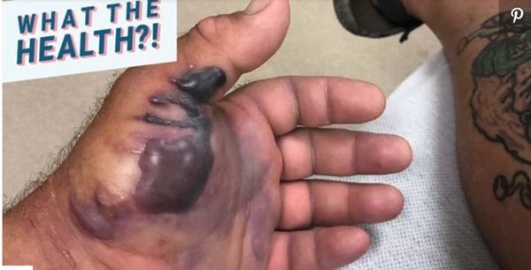 Nhiều người gặp nạn do vi khuẩn ăn thịt người tấn công: Đây là cách phòng tránh đúng nhất-4