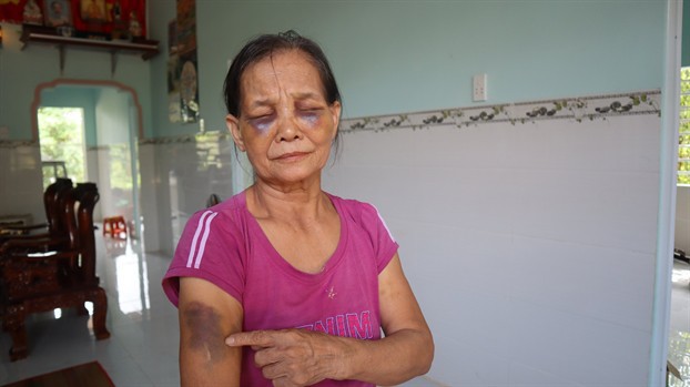 Nàng dâu đánh mẹ chồng đến thâm tím mặt mày lên tiếng: Tôi chịu đựng đã nhiều, không chịu được nữa mới làm to chuyện-1