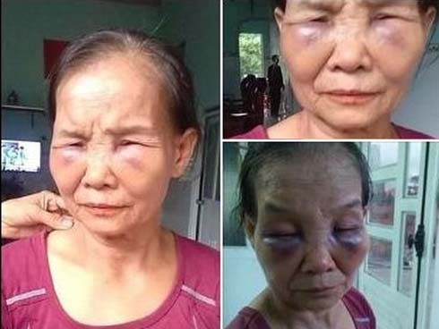 Con dâu đánh mẹ chồng bầm tím mắt ân hận xin lỗi nhưng vẫn chưa được đồng ý cho về ở chung nhà-2