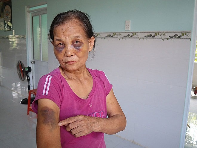 Con dâu đánh mẹ chồng bầm tím mắt ân hận xin lỗi nhưng vẫn chưa được đồng ý cho về ở chung nhà-1