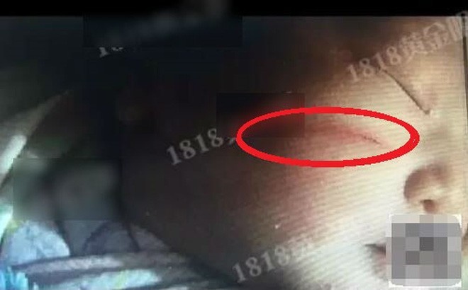 Những trẻ chào đời bị rách mặt, gãy chân tay do lỗi bác sĩ khiến các mẹ bầu hết hồn, nhiều trường hợp bác sĩ giải thích khó nghe-5