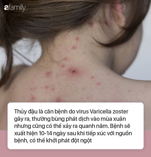 Bệnh thủy đậu: 4 hiểu lầm tai hại khiến mẹ càng chữa, con càng bị nặng thêm-1