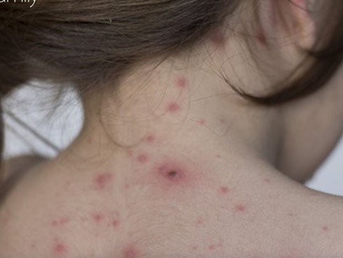 Sự thật về hai loại thuốc xanh, đỏ người mắc thủy đậu hay dùng-2