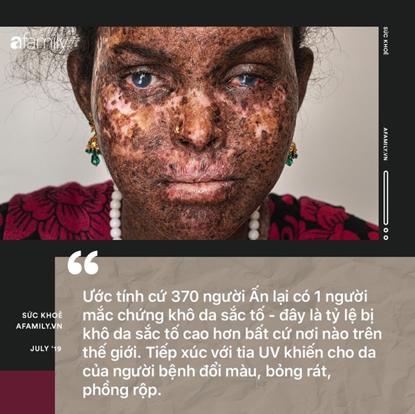 Hậu quả từ các cuộc hôn nhân cận huyết: Những đứa trẻ đang chết dần chết mòn bởi… ánh nắng mặt trời-2