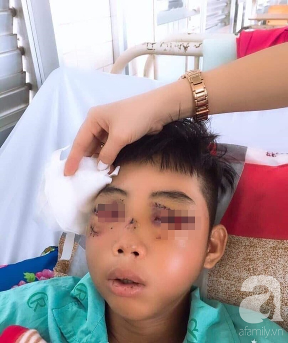 Đi phụ hồ giúp gia đình, bé trai 15 tuổi bị cây đâm xuyên mặt, phải bỏ một bên mắt-1