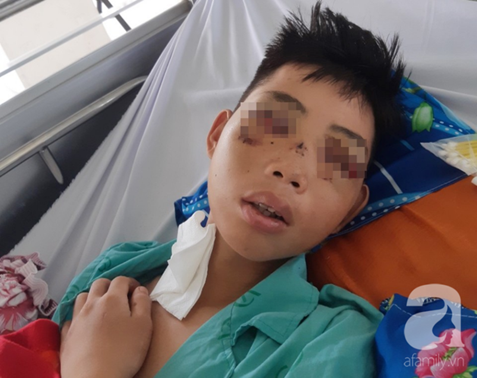 Đi phụ hồ giúp gia đình, bé trai 15 tuổi bị cây đâm xuyên mặt, phải bỏ một bên mắt-3