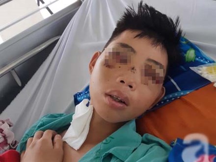 Đi phụ hồ giúp gia đình, bé trai 15 tuổi bị cây đâm xuyên mặt, phải bỏ một bên mắt