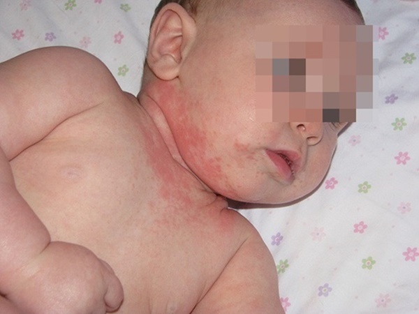 Bé 6,5 tháng ăn trứng xong suy hô hấp: BS cảnh báo dấu hiệu dị ứng mẹ cần biết để con không nguy hiểm-2