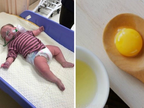 Bé 6,5 tháng ăn trứng xong suy hô hấp: BS cảnh báo dấu hiệu dị ứng mẹ cần biết để con không nguy hiểm