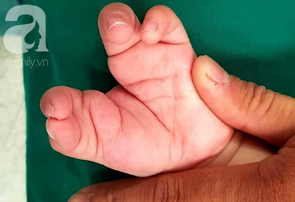 TP.HCM: Mẹ nghẹn ngào khi con trai 2 tuổi mắc hội chứng tôm hùm vô cùng hiếm gặp khiến tay chân dị dạng-1