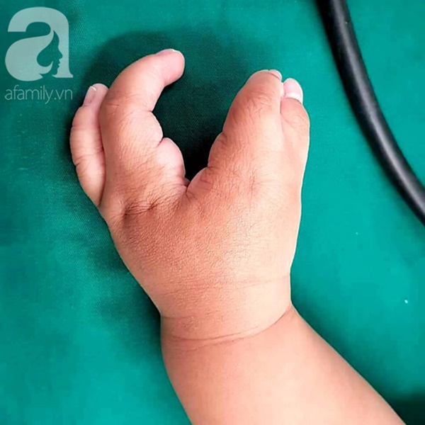TP.HCM: Mẹ nghẹn ngào khi con trai 2 tuổi mắc hội chứng tôm hùm vô cùng hiếm gặp khiến tay chân dị dạng-3