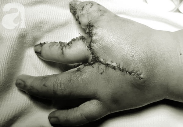 TP.HCM: Mẹ nghẹn ngào khi con trai 2 tuổi mắc hội chứng tôm hùm vô cùng hiếm gặp khiến tay chân dị dạng-4