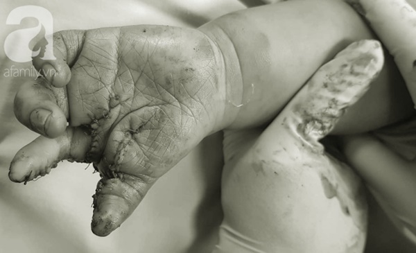 TP.HCM: Mẹ nghẹn ngào khi con trai 2 tuổi mắc hội chứng tôm hùm vô cùng hiếm gặp khiến tay chân dị dạng-5