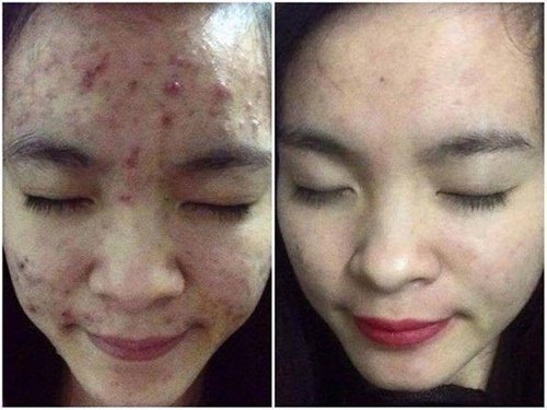 Vài quả chuối xanh hơn cả mỹ phẩm đắt tiền, vừa dưỡng trắng da lại trị sạch mụn-5