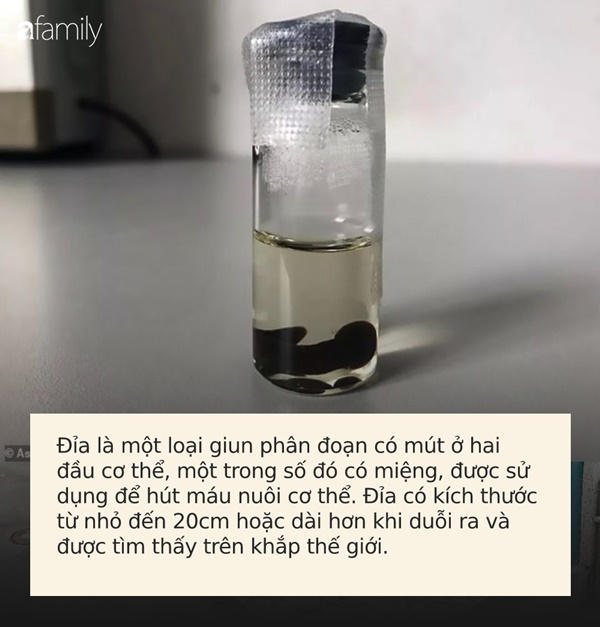 Phát hiện đỉa 3cm nằm quằn quại trong cổ họng người phụ nữ, nguyên do là vì 1 thói quen nhiều người mắc-5