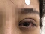 Kinh hãi khi tận mắt thấy hành trình mò kim trong mắt cho cô gái sau trải nghiệm nhấn mí mắt tại spa-5