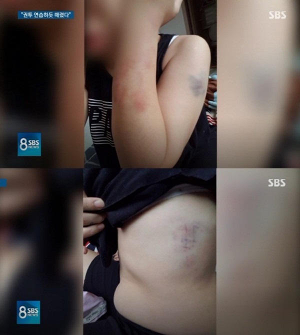 SBS công khai hình ảnh thương tích của cô dâu Việt sau khi bị chồng người Hàn bạo hành, một lần nữa khiến dân mạng căm phẫn-3