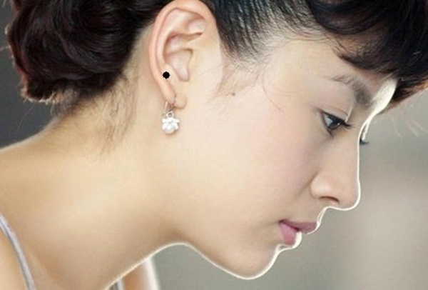 5 nốt ruồi được cho là khắc chồng, lăng nhăng, dễ ngoại tình, nhất định phải xóa-3