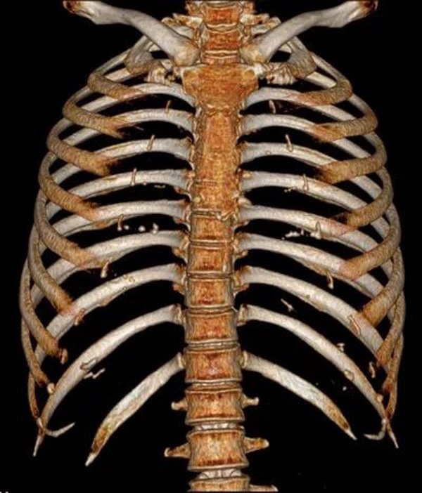 Sau cái ôm của bạn trai, cô gái phải nhập viện và nhận kết quả choáng váng-1