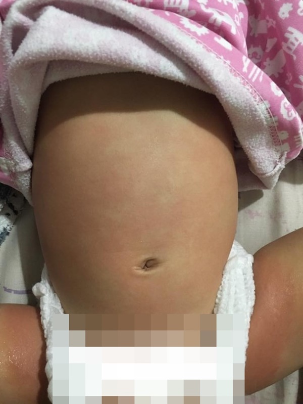 Ngồi vào ghế ăn của nhà hàng được một lúc thì con gái dị ứng khắp cơ thể, người mẹ cảnh báo việc cần làm khi cho con ra ngoài ăn-3