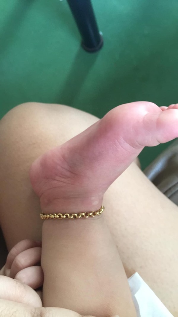 Ngồi vào ghế ăn của nhà hàng được một lúc thì con gái dị ứng khắp cơ thể, người mẹ cảnh báo việc cần làm khi cho con ra ngoài ăn-6