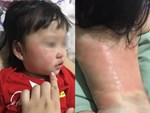 Chứng dị ứng nước quái đản khiến cô gái không thể tắm, khóc hay toát mồ hôi vì sẽ bị phát ban kín người-4