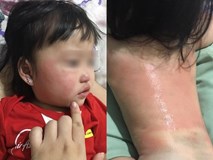 Ngồi vào ghế ăn của nhà hàng được một lúc thì con gái dị ứng khắp cơ thể, người mẹ cảnh báo việc cần làm khi cho con ra ngoài ăn Ngồi vào ghế ăn của nhà hàng được một lúc thì con gái dị ứng khắp cơ thể, người mẹ cảnh báo việc cần làm khi cho con ra ngoài ăn