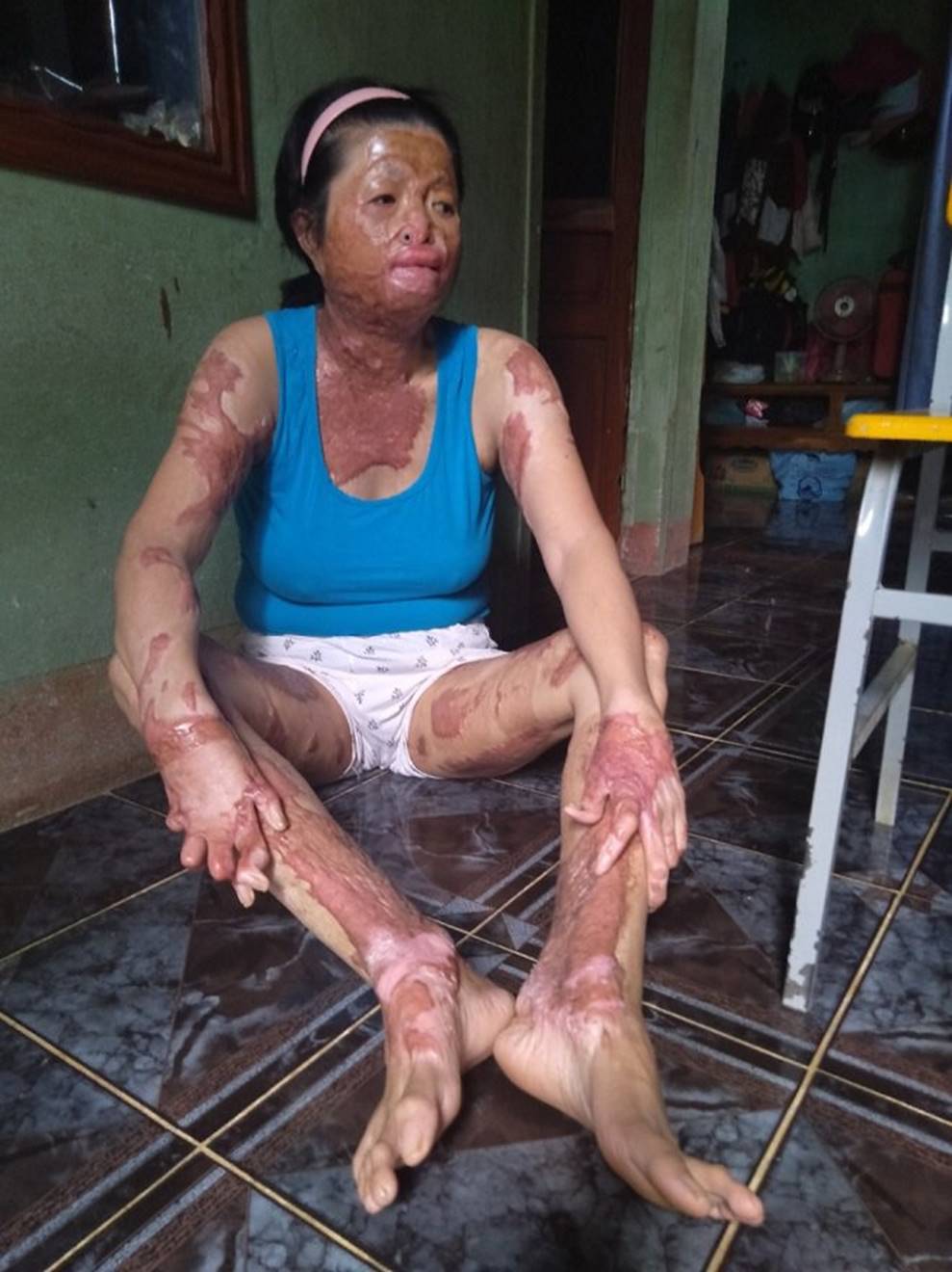 Bỏng xăng toàn thân cháy đen, mẹ khóc nấc nghe con nói mẹ là người mẹ vĩ đại nhất-5