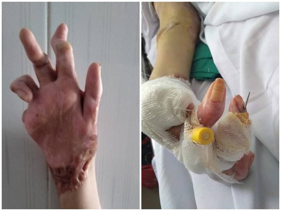 Bỏng xăng toàn thân cháy đen, mẹ khóc nấc nghe con nói mẹ là người mẹ vĩ đại nhất-6