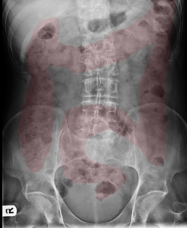 Bé gái 11 tuổi nhập viện cấp cứu vì đau dạ dày, bác sĩ chỉ đích danh thủ phạm là 1 sở thích tai hại của rất nhiều bé-2