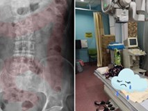 Bé gái 11 tuổi nhập viện cấp cứu vì đau dạ dày, bác sĩ chỉ đích danh thủ phạm là 1 sở thích tai hại của rất nhiều bé Bé gái 11 tuổi nhập viện cấp cứu vì đau dạ dày, bác sĩ chỉ đích danh thủ phạm là 1 sở thích tai hại của rất nhiều bé