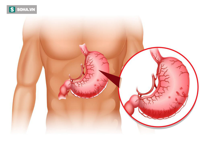 Tại sao bệnh dạ dày lại có thể tiến triển thành ung thư: Nhiều người không chú ý điều này-1