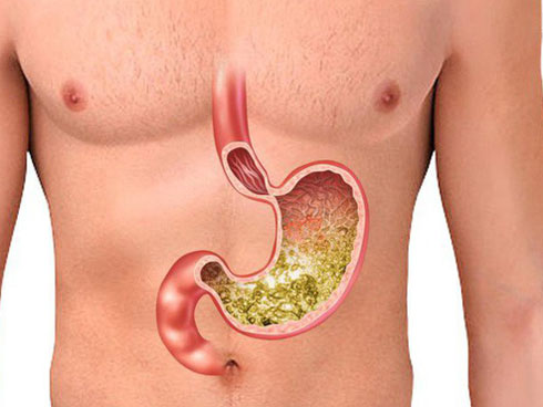 Bệnh xuất huyết dạ dày khiến Nhã trong Về Nhà đi con phải đi cấp cứu: Chuyên gia chỉ ra 5 nguyên nhân và cách điều trị hiệu quả-5