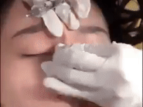 RÙNG MÌNH và PHẪN NỘ trước clip tiêm filler rồi nắn sống mũi như nặn đất sét của cô gái trẻ