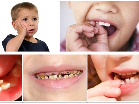 Bé 3 tuổi nghiện kẹo nhưng lười đánh răng, bố mẹ sốc khi con bị vi khuẩn ăn lên mắt