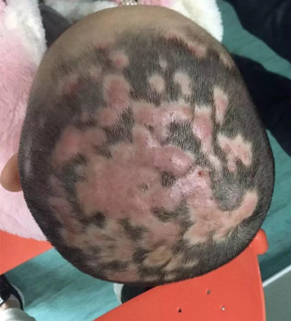 Tóc bé gái 5 tuổi rụng từng mảng vô cùng đáng sợ, lý do là chơi với thứ này trong nhà-1