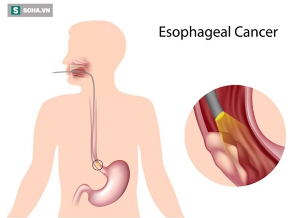 Bác sĩ khuyến cáo 3 yếu tố phổ biến có thể gây ung thư thực quản, ai cũng nên tránh-1