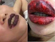 Rùng mình đôi môi cô gái trẻ sưng như 2 miếng thịt bò khô vì phun xăm hỏng, cứ nói 1 câu lại ứa máu đau đớn Rùng mình đôi môi cô gái trẻ sưng như 2 miếng thịt bò khô vì phun xăm hỏng, cứ nói 1 câu lại ứa máu đau đớn