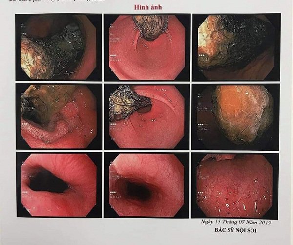 Thấy con mất từng mảng tóc, lại kêu đau bụng, đi khám người mẹ ngỡ ngàng khi biết sự thật-1