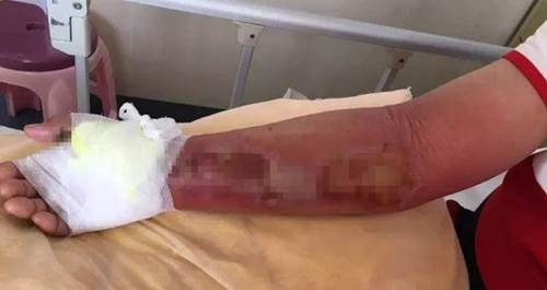 Người đàn ông suýt phải cắt cụt tay chỉ vì vết thương nhỏ sau khi bị đuôi tôm đâm-2