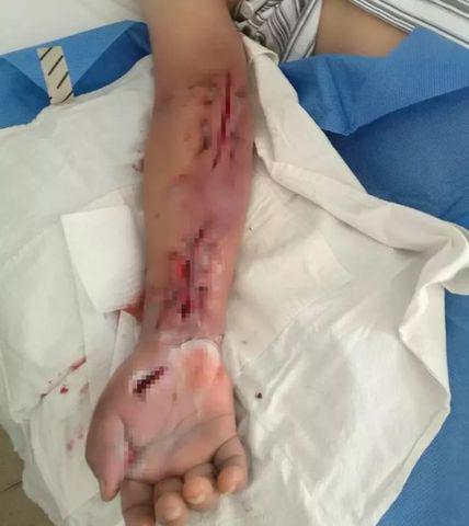 Người đàn ông suýt phải cắt cụt tay chỉ vì vết thương nhỏ sau khi bị đuôi tôm đâm-4
