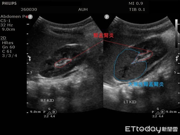 Bé trai sốt 5 ngày không khỏi, nhiễm trùng cao gấp 13 lần thông thường: Bác sĩ nhắc mẹ việc cần làm khi con bị sốt-2