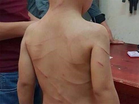 Nghi án cháu bé bị hàng xóm đánh nhập viện chỉ vì 2 gia đình mâu thuẫn