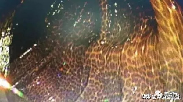 Tin bạn hơn tin bác sĩ khi chữa táo bón, người phụ nữ lĩnh” hậu quả là ruột đen xì, lốm đốm như da báo-2