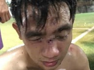 Hà Nội: Tranh chấp khi đá bóng, 15 cầu thủ lao vào đánh đối phương nhập viện