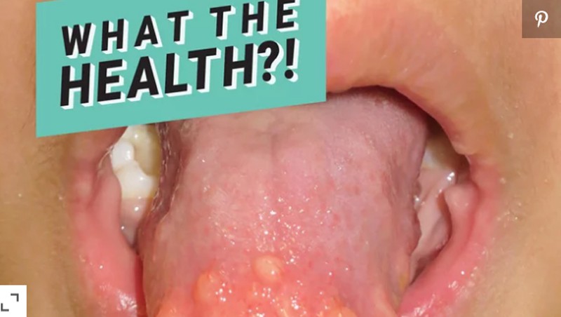 Nếu lưỡi của con bạn có dấu hiệu tương tự như em bé này, cẩn thận với bệnh ung thư tuyến giáp!-1