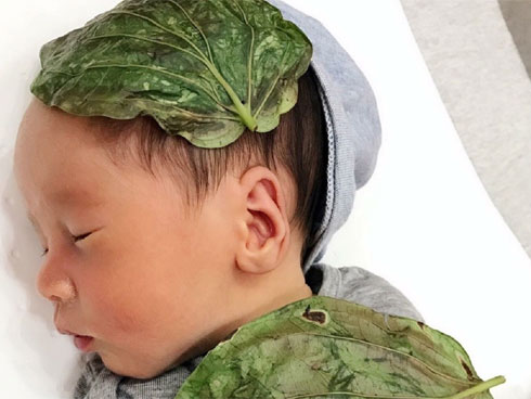 Cô gái 16 tuổi bị bỏng nắng nghiêm trọng, khiến vùng lưng nổi đầy mụn nước siêu to khổng lồ-6